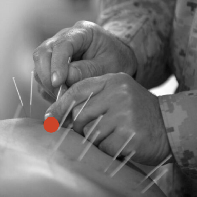 Châm cứu